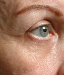 療程前<br>眼周及眼紋
